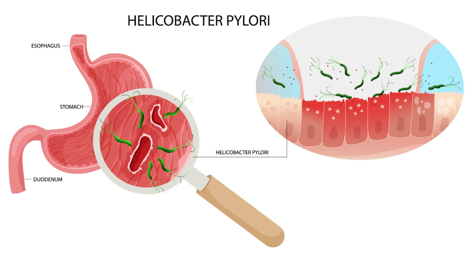 helikobakter-pilori